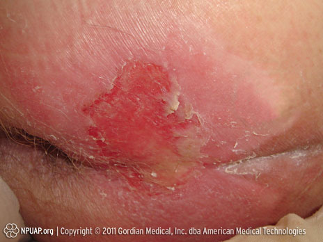 Tryksår kategori II: Delvist tab af hudtykkelse eller blærer 
