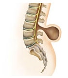 Meningocele (hjernebrok)