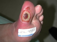 Inficeret fodsår