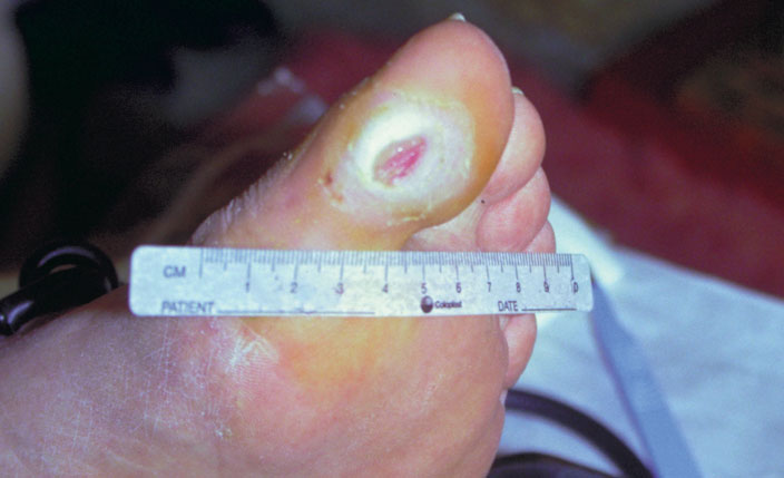 neuropatisk fodsår