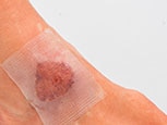 Wound care