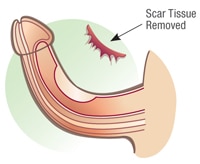 fjernelse af arvæv på penis