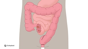 Loop-ileostomi og j-formet pose med fjernelse af endetarm