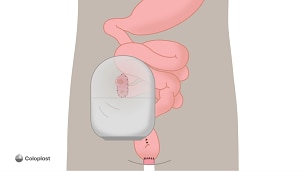 Loop-ileostomi og j-formet pose med fjernelse af tyktarm og endetarm