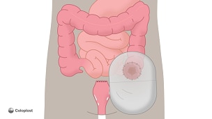Ende-kolostomi med fjernelse af colon sigmoideum