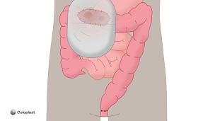 Loop-kolostomi med fjernelse af endetarm  