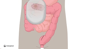 Loop-kolostomi og j-formet pose med fjernelse af endetarm  