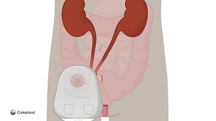 Urostomi fra tyndtarmssegment med fjernelse af blæren