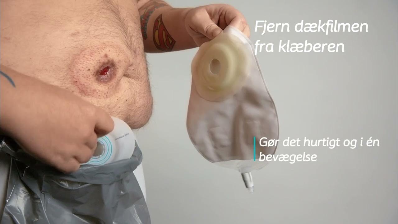 NY urostomipose med drejelukning 1-dels Convex