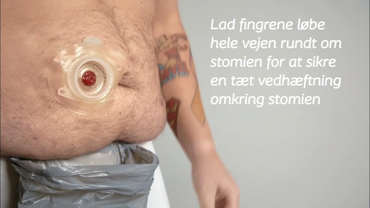 NY urostomipose med drejelukning 2-dels Flex Convex